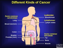 Types de cancers
