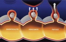 Diverticules sigmoïdiens