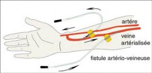 Fistule artério-veineuse