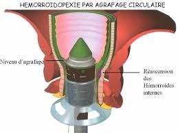 Les Hémorroïdes: Définition, Causes, Symptômes Et Evolution - Docteur Amine  Sinacer