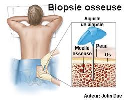 Biopsie médullaire