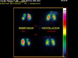 Scintigraphie ventilation - perfusion