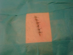 Incision suturée