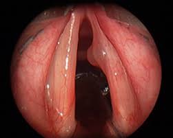 Polype des cordes vocales