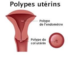 Polypes utérins